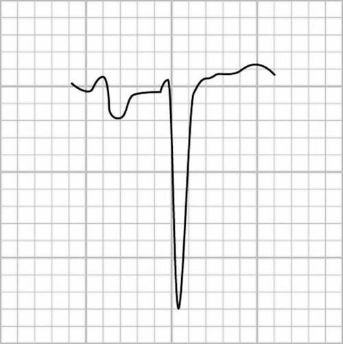بزرگی دهلیز چپ در موج P لید V1
