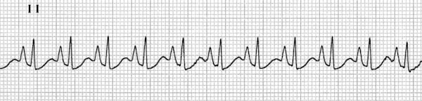 الگوی P pulmonale در بزرگی دهلیز راست