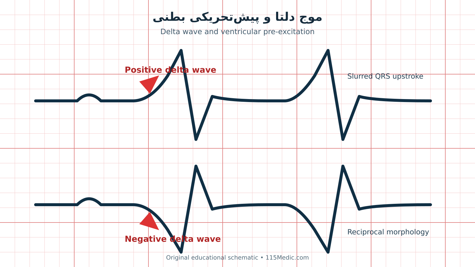موج دلتا در ECG و نمونه پیش‌تحریکی بطنی