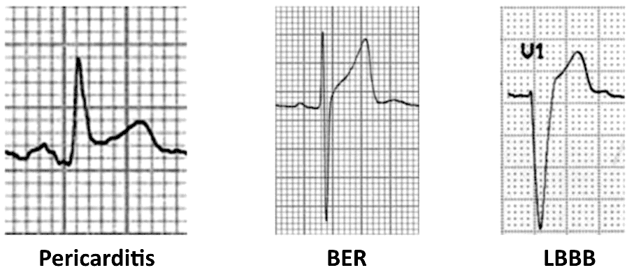 مقایسه بالا رفتن قطعه ST در پریکاردیت رپلاریزاسیون زودرس و LBBB