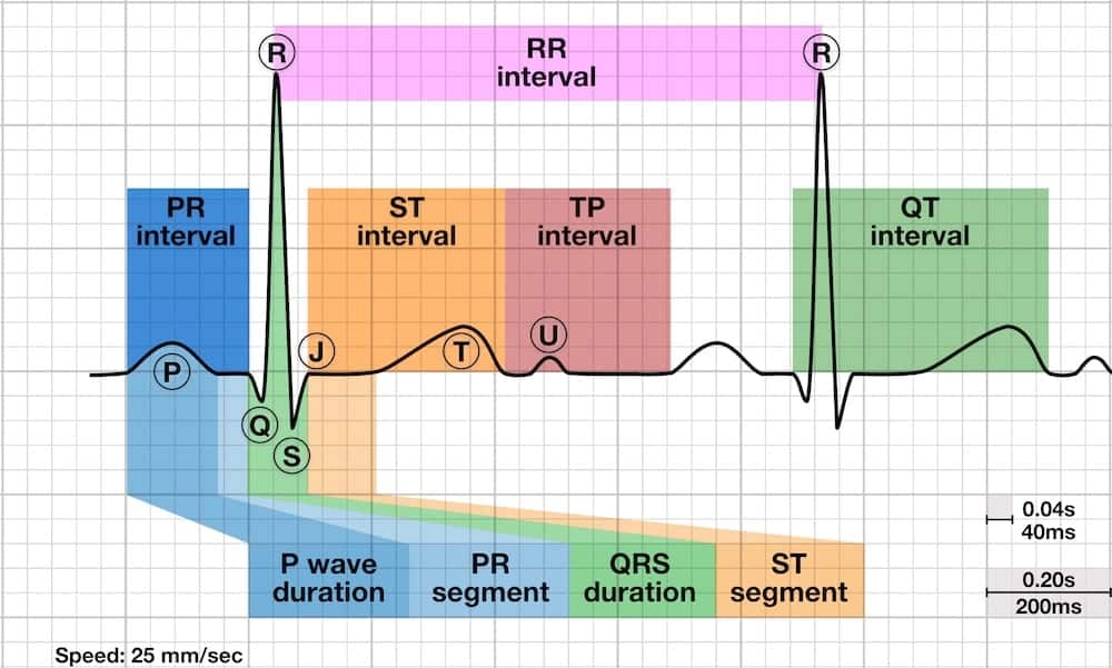 اجزای موج ECG و محل فاصله PR